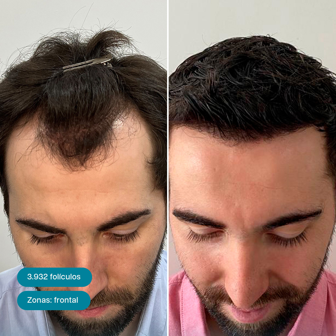 Antes e Depois 14